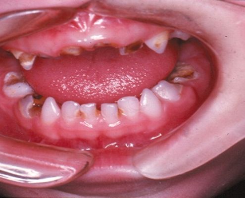 پوسیدگی در دندانهای شیری