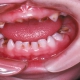 پوسیدگی در دندانهای شیری