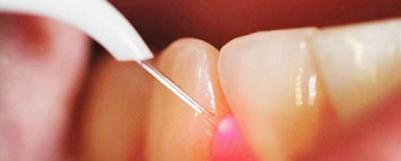 درمان دندانپزشکی با لیزر