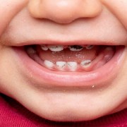 متخصص دندانپزشک کودکان کاشان |پوسیدگی دندان کودکان