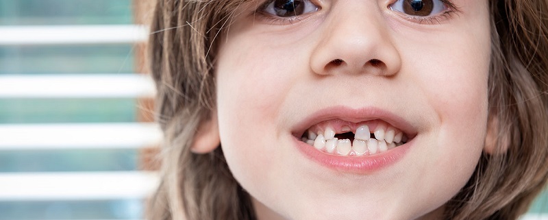 متخصص دندانپزشک کودکان کاشان | تروما دندان کودکان
