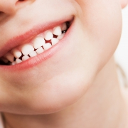متخصص دندانپزشک کودکان کاشان | تغییر رنگ دندان با قطره آهن !