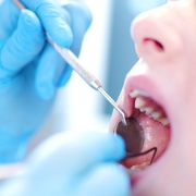 متخصص دندانپزشک کودکان کاشان| دلیل بروز لک سفید بر روی دندان کودکان