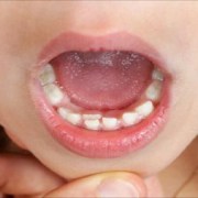 متخصص دندانپزشک کودکان کاشان |تاثیر ارتودنسی در دندان کوسه ای
