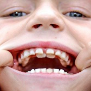 متخصص دندانپزشک کودکان کاشان | دندان کوسه ای و درمان فوری آن