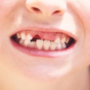 متخصص دندانپزشک کودکان کاشان |افزایش استحکام دندان دائمی