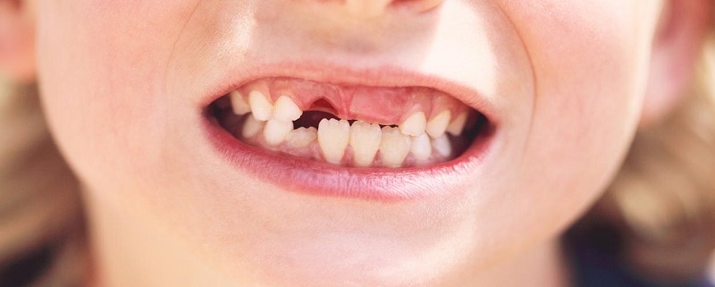 متخصص دندانپزشک کودکان کاشان |افزایش استحکام دندان دائمی