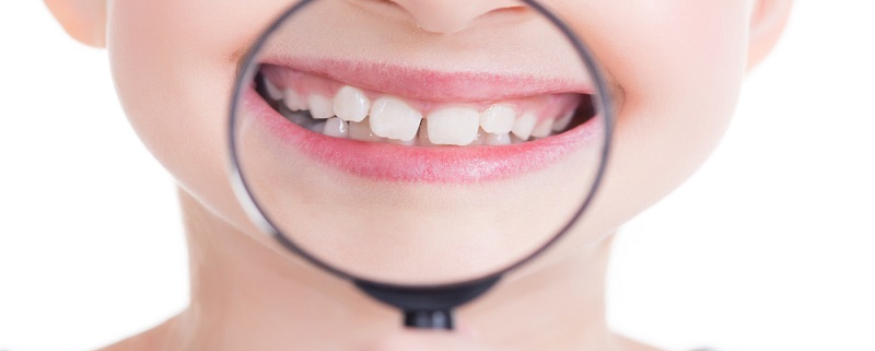 متخصص دندانپزشک کودکان کاشان | فاصله بین دندان