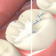 فیشورسیلانت یا شیاربندی دندان چیست؟ | متخصص دندانپزشک کودکان کاشان