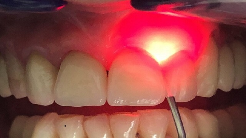 کاربرد لیزردرمانی در دندانپزشکی(قسمت اول) | متخصص دندانپزشک کودکان کاشان