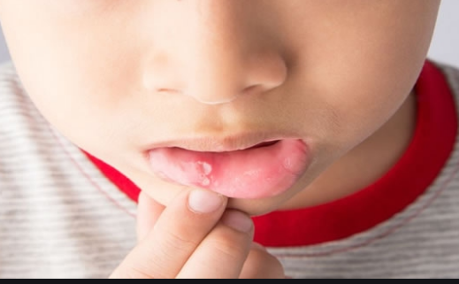 علت زخم دهان کودکان بعد از مراجعه به دندانپزشکی | متخصص دندانپزشک کودکان اصفهان