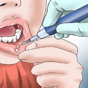 علت زخم دهان کودکان بعد از مراجعه به دندانپزشکی | متخصص دندانپزشک کودکان اصفهان