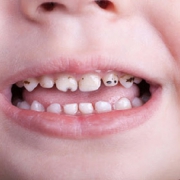 لکه سیاه دندان کودکان برای چیست؟ | متخصص دندانپزشک کودکان اصفهان