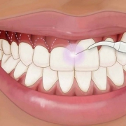 کاربرد لیزردرمانی در دندانپزشکی(قسمت اول) | متخصص دندانپزشک کودکان کاشان