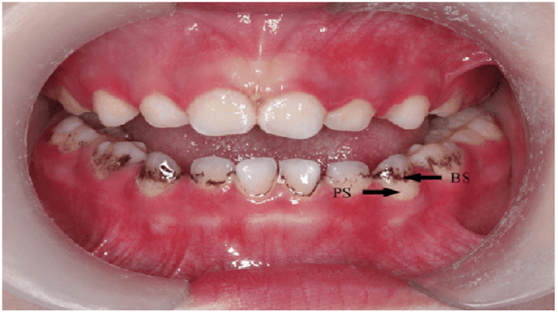 درمان لک سیاه دندان کودکان چگونه است؟ | متخصص دندانپزک کودکان کاشان