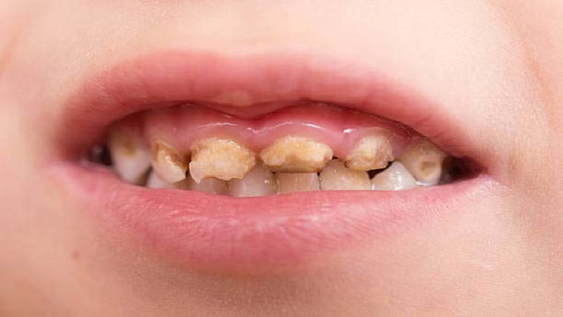 روشهای ترمیم دندان شیری کودکان | متخصص دندانپزشک کودکان کاشان