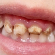 علت لک سیاه دندان کودکان چیست؟ | متخصص دندانپزشک کودکان کاشان