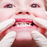 پیشگیری از لک دندان کودکان | متخصص دندانپزشک کودکان کاشان