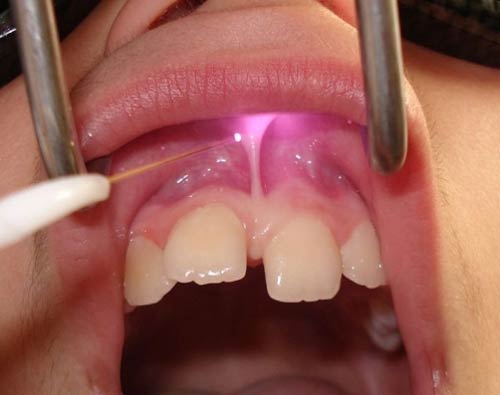 کاربرد لیزر در دندانپزشکی(قسمت سوم) | متخصص دندانپزشک کودکان کاشان