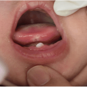 دندان های ناتال و نئوناتال | متخصص دندانپزشک کودکان کاشان