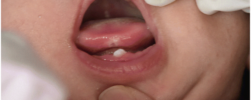 دندان های ناتال و نئوناتال | متخصص دندانپزشک کودکان کاشان