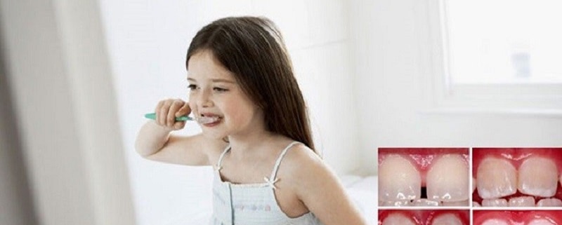 فلوروزیس دندانی | متخصص دندانپزشک کودکان کاشان