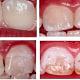 عوامل فلوروزیس دندانی | متخصص دندانپزشک کودکان کاشان