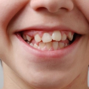 جلوگیری از کج درآمدن دندان شیری | متخصص دندانپزشک کودکان کاشان