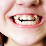 کج درآمدن دندان نوزاد و دلایل آن | متخصص دندانپزشک کودکان کاشان