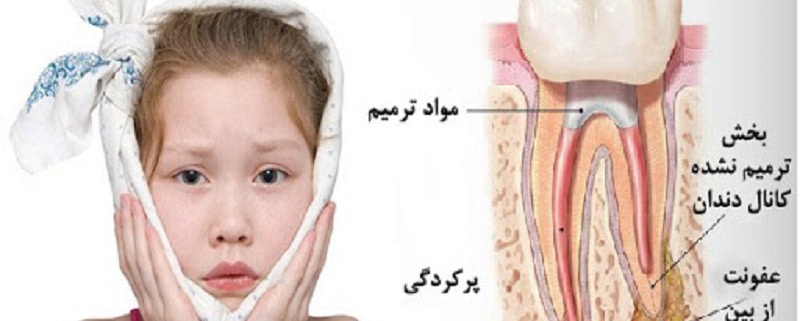 التهاب بعد از عصب کشی در کودکان | متخصص دندانپزشک کودکان کاشان