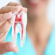 اهمیت وارنیش فلوراید تراپی | متخصص دندانپزشک کودکان کاشان
