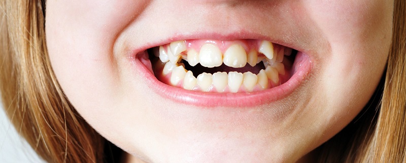 تاثیر دندان کج و نامتناسب بر سلامت عمومی کودک | متخصص دندانپزشک کودکان کاشان