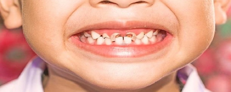 ضرورت درمان پوسیدگی دندانهای شیری | متخصص دندانپزشک کودکان کاشان