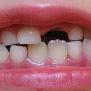 علت دیر افتادن دندان شیری | متخصص دندانپزشک کودکان کاشان