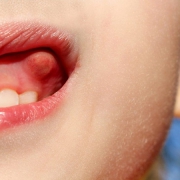 آشنایی با کیست دندان در کودکان | متخصص دندانپزشک کودکان کاشان
