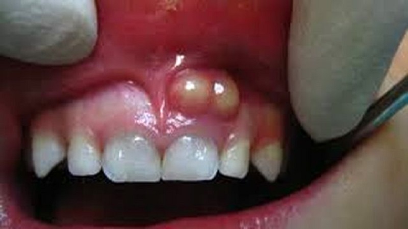 آشنایی با کیست دندان در کودکان | متخصص دندانپزشک کودکان کاشان