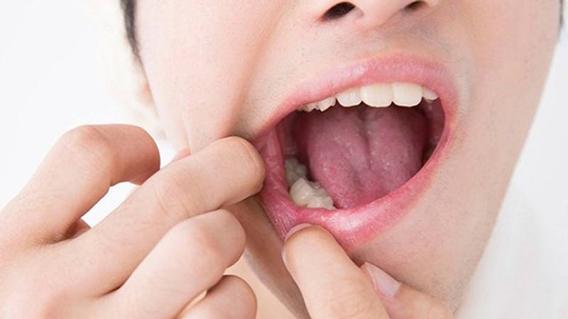 انواع کیست دندان | متخصص دندانپزشک کودکان کاشان