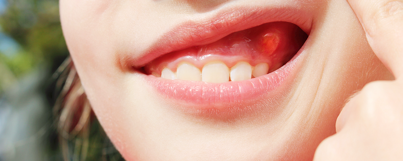 انواع کیست دندان | متخصص دندانپزشک کودکان کاشان