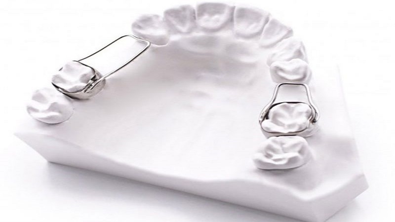 انواع فضانگهدارنده | متخصص دندانپزشک کودکان کاشانَ