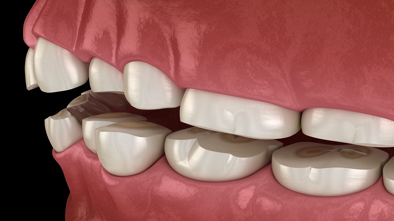 دندان قروچه یا براکسیسم در کودکان چیست | متخصص دندانپزشک کودکان کاشان