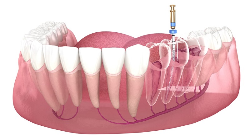 عوامل موثر در آسیب پالپ | متخصص دندانپزشک کودکان کاشان 