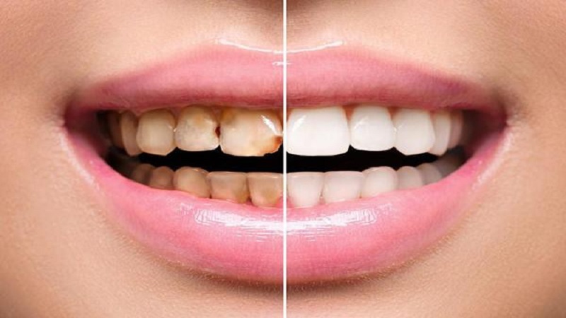 انواع لکه های دندان و درمان آن | متخصص دندانپزشک کودکان کاشان