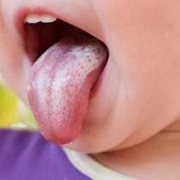 تشخیص و درمان برفک دهان | متخصص دندانپزشک کودکان کاشان