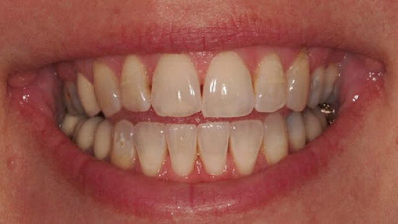 سیاه شدن بین دو دندان | متخصص دندانپزشک کودکان کاشان