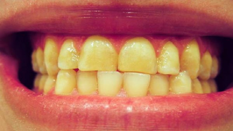 علت و انواع تغییر رنگ دندان | متخصص دندانپزشک کودکان کاشان