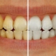 علت و انواع تغییر رنگ دندان | متخصص دندانپزشک کودکان کاشان