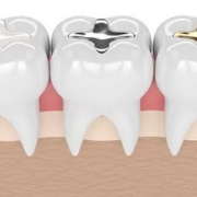پر کردن دندان با مواد همرنگ | متخصص دندانپزشک کودکان کاشان