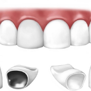 کاربردهای روکش دندان در دندانپزشکی | متخصص دندانپزشک کودکان کاشان