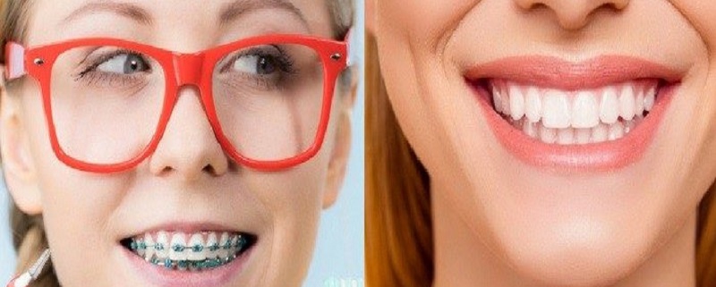 ارتودنسی بهتر است یا لمینت دندان؟ | متخصص دندانپزشک کودکان کاشان