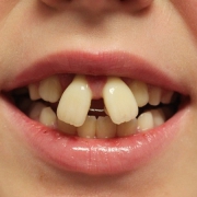 ارتودنسی دو دندان جلو | متخصص دندانپزشک کودکان کاشان
